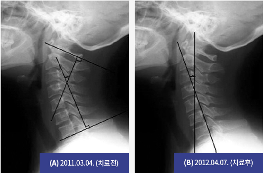 추나요법 효과